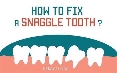 How To Fix A Snaggle Tooth These 5 Fastest Ways Teeth Fix It Invisalign