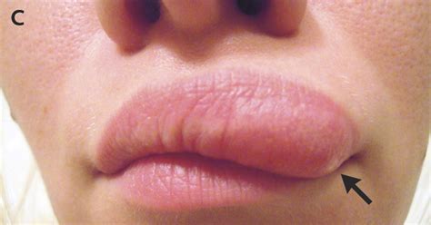 Worm Lips