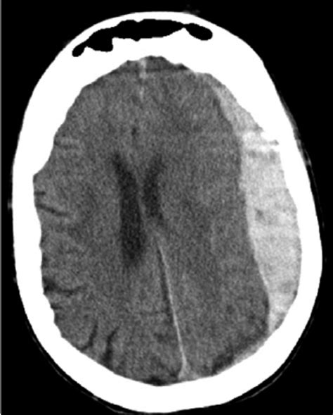 Subarachnoid Hemorrhage On Computerized Tomography Scan Hyperdense