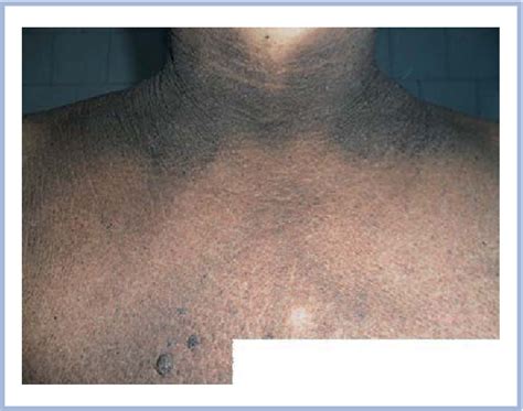 Figure 1 From Malignant Acanthosis Nigricans As The Marker Of A