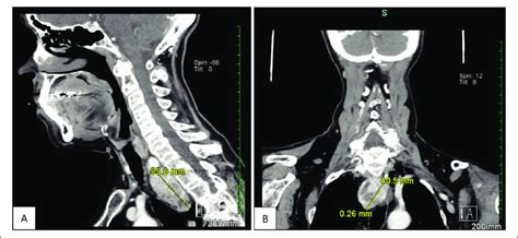 Contrast Enhanced Computed Tomography Of The Neck Showing A
