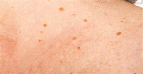 The 5 Lesser Know Pregnancy Skin Issues From Acne To Melasma