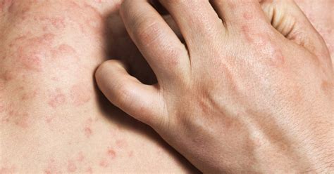 common shingles rash sites livestrong