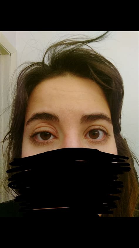 Help I Woke Up With A Swollen Eyelid Raccutane