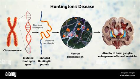 Molecular Genesis Of Huntingtons Disease Computer Illustration