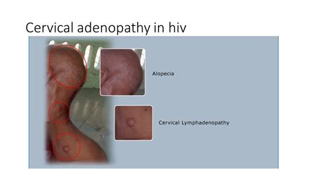 Cervical Adenopathy Is Very Common In Hiv Patients Most Coomon Cause