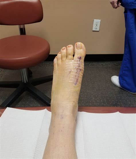 Walking Boot After Bunion Surgery Boot For Broken Foot Buy Short