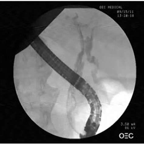 Endoscopic Retrograde Cholangiopancreatography Ercp Showing The