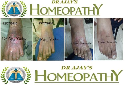 Dr Ajays Homeopathy Effective And Long Lasting Answer For Eczema Is