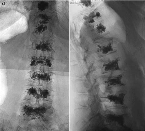 Ctx Ray Guided Augmentation Techniques In Lumbar Spine Neupsy Key