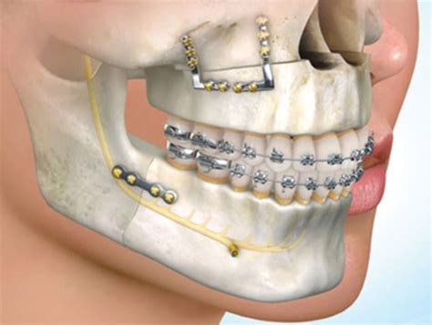 Orthognathic Surgery By Dr Issembert Orthodontist
