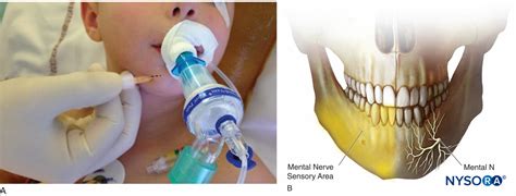 Regional Anesthesia Mental Nerve Block Sensory Area Of The Mental Nerve