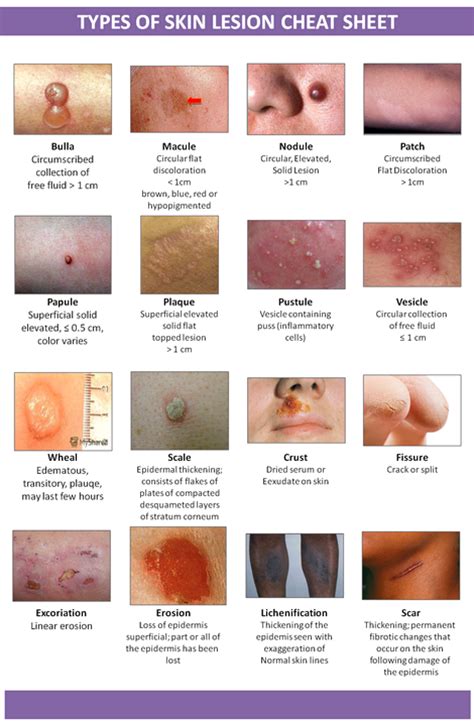 Types Of Skin Lesion Studypk