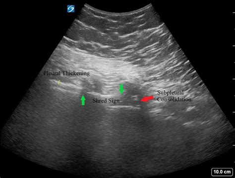Re Demonstration Of Pleural Thickening Yellow Bracket Shred Sign Is