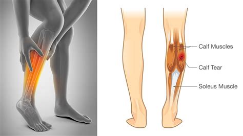What Is The Anatomical Term For Your Calf Muscle Of The Lower Leg How