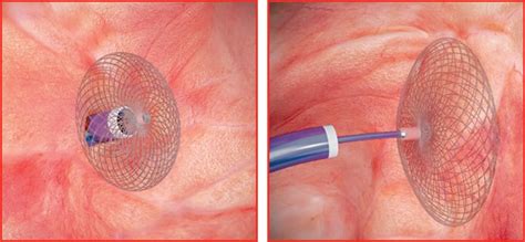 Patent Foramen Ovale Preventing The Potential For Recurrent Stroke Nyp