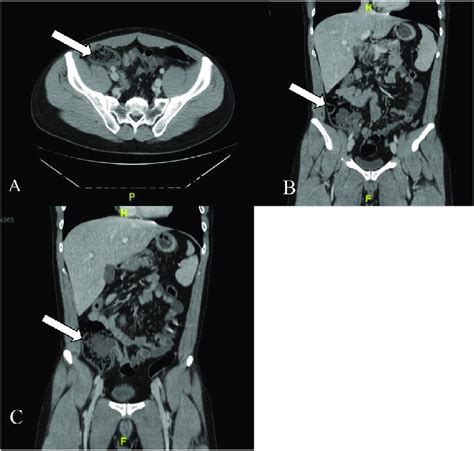 A Acute Appendicitis Right Lower Quadrant Abdomenpelvis Ct Scan