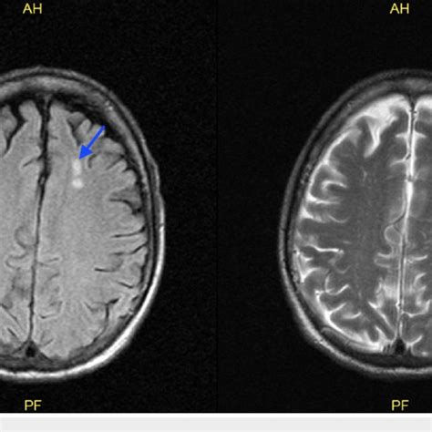 Mri Brain Without Contrast Showing Nonspecific White Matter Lesions In
