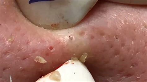 Pimple Popping Videos 2022 Blackheads Youtube Youtube