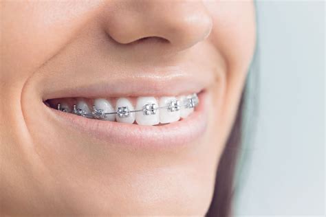 10 Braces Myths You Need To Know Sawgrass Orthodontics