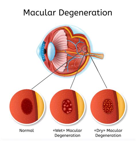 Macular Degeneration Treatment Stockton Manteca Ca