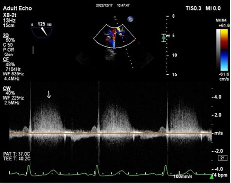 A Pregnant Woman With An Extra Cardiac Cavity An Acquired Iatrogenic Complication— A Case