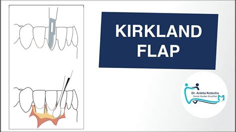 Kirkland Flap Access Flap Modified Flap Operation Periodontal Flap