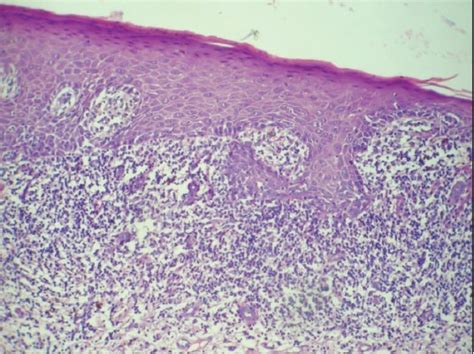 Photomicrograph Of Oral Lichen Planus Showing Basal Cell Degeneration