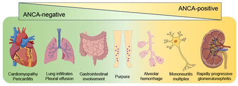 Jcm Free Full Text Eosinophilic Granulomatosis With Polyangiitis