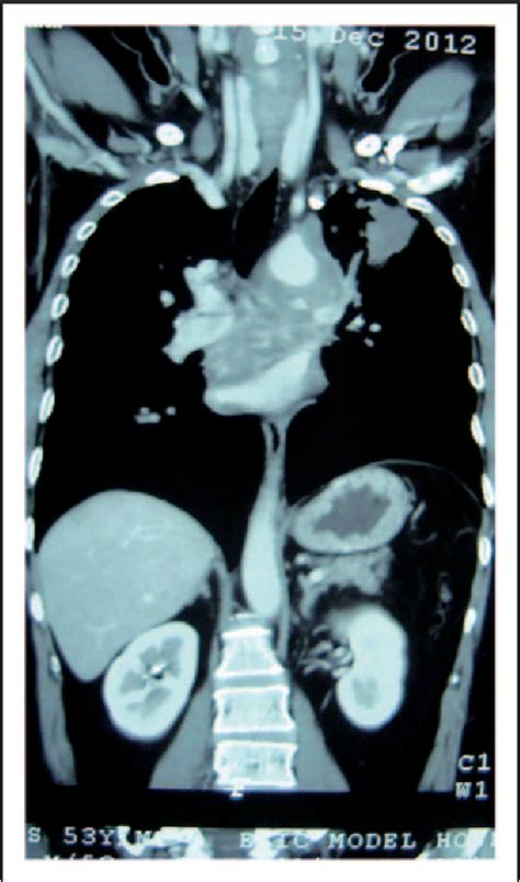 Figure 1 From Tuberculosis Presenting As Mediastinal And Lung Mass