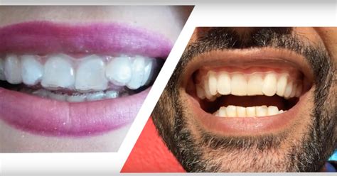 But braces give you an unattractive look and the treatment usually goes very long and very expensive. Home Teeth Straightening in the UK - Dr Muzzafar Zaman