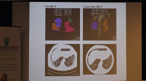 Stem Cell Therapy For Scleroderma By Richard Burt Md Youtube