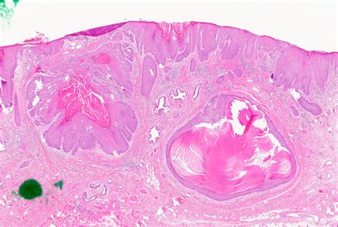 Pathology Outlines Hpv Associated Squamous Cell Carcinoma