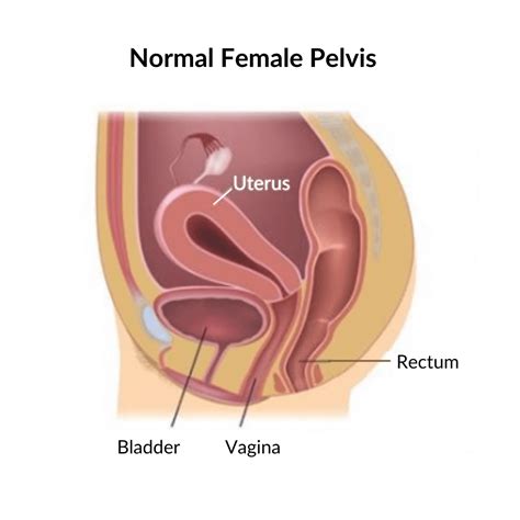 Identifying And Treating Pelvic Organ Prolapse