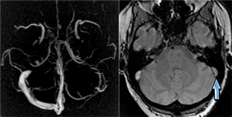 Cerebral venous sinus thrombosis as presenting feature of ulcerative colitis. The Radiology Assistant : Cerebral Venous Thrombosis
