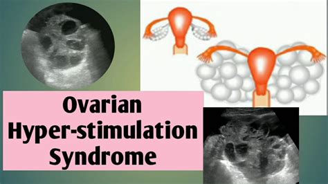Case Report Ovarian Hyper Stimulation Syndrome Ohss🤰🤰usg Imaging