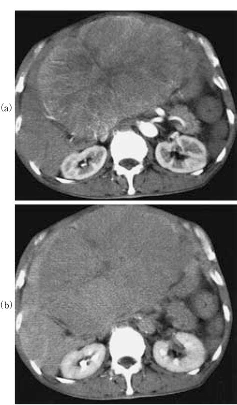 Figure 1 From A Case Of Giant Liver Metastases From Rectal Carcinoid