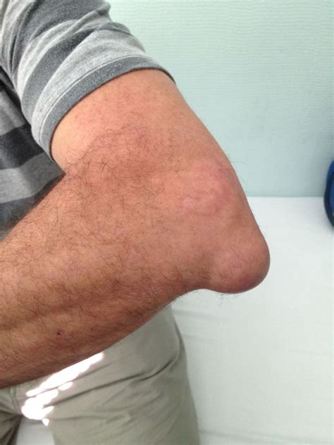 Elbow Bursitis Doccheck