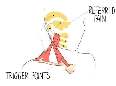 Trigger Points Beth Forrest Osteopathy