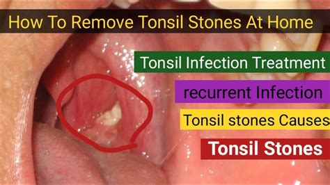 Tonsil Stones Removal L Wrost Tonsil Stones Removal L Big Tonsil Stones
