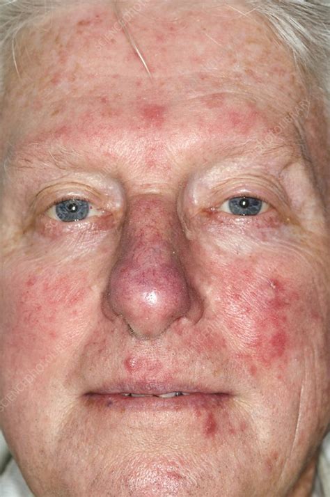 acne rosacea on the face stock image c002 9590 science photo library