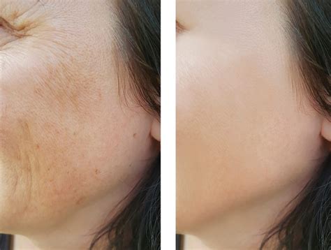 Pigmentation And Uneven Skin Tone Causes And Treatments Revival Medi Spa