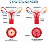 Photos of Cervical Cancer During Pregnancy Treatment