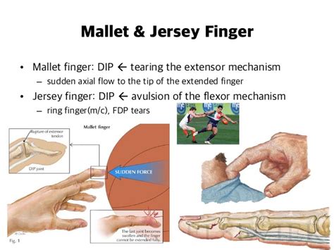 Mechanism of injury—injury occurs when a flexed dip joint is forcefully hyperextended and the fdp tendon ruptures at its weakest point, which is the insertion site (figure 35.2). Emergency Radiology: Shoulder & Upper Extremities