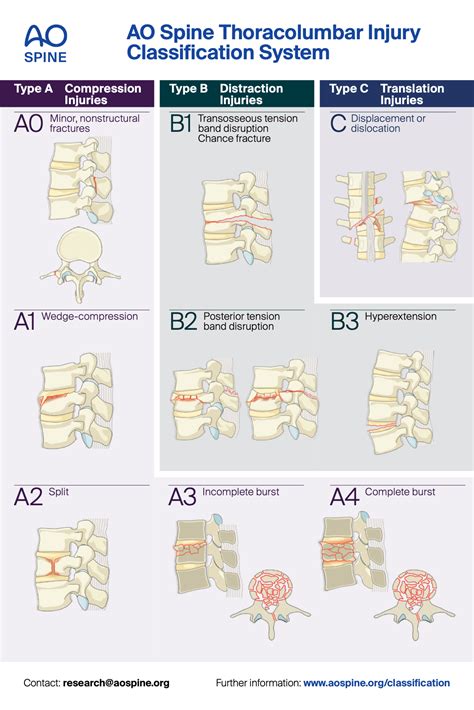 AO Spine Thoracolumbar Fracture Classification UW Emergency Radiology