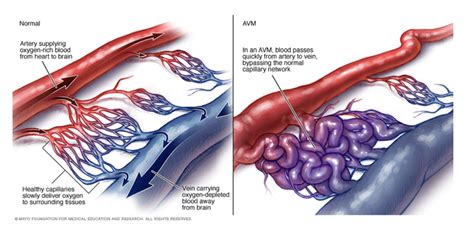 Arteriovenous Malformations Reeve Foundation