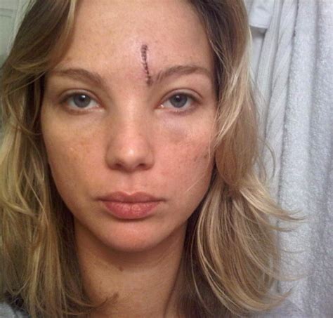 World Renowned Model Sustains Permanent Facial Scars From Horrific Taxi