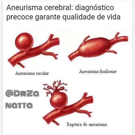 O que é um Aneurisma Cerebral Alvorada em Foco