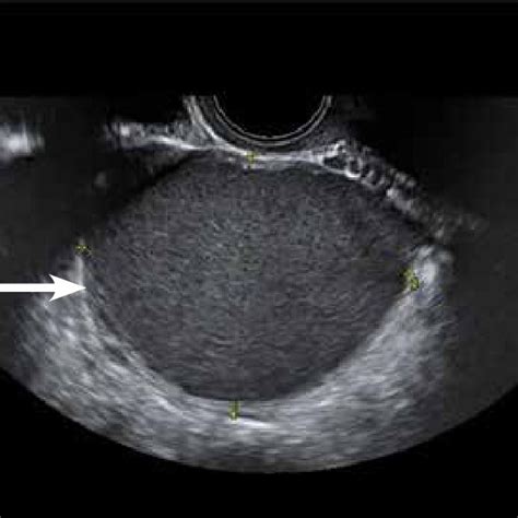 Transvaginal Ultrasonography In The Sagittal Plane Shows An