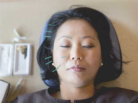 Acupuncture For Headaches And Migraines How It Works Acupuncture